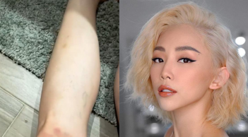 Tóc Tiên gây lo lắng với hình ảnh chân tay bầm dập sau 3 đêm biểu diễn cực sung