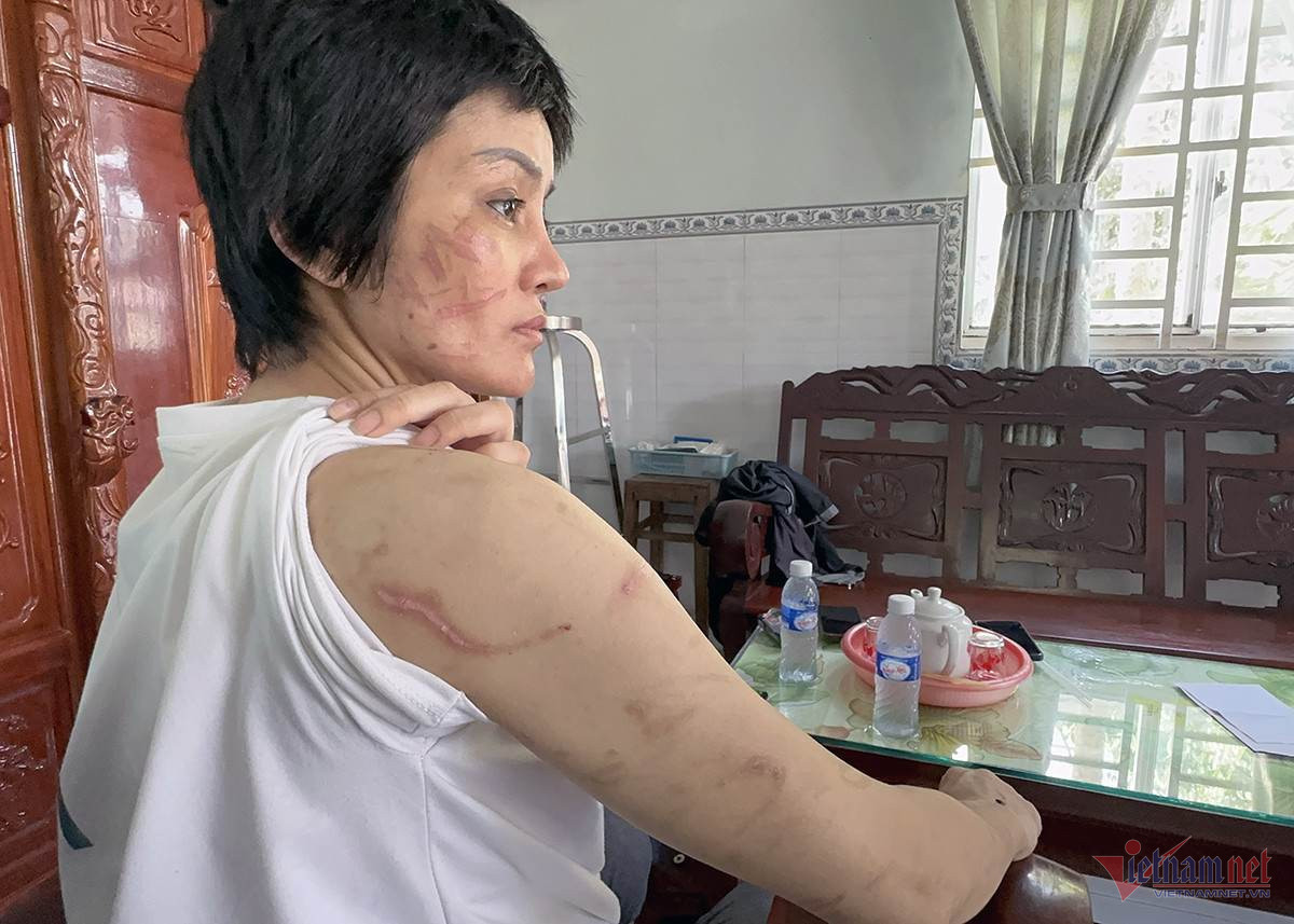 205 vết thương trên người vợ bầu 7 tháng, là tra tấn chứ không phải bạo lực 